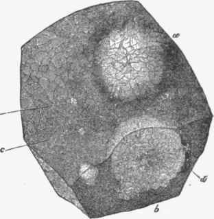 Piece of liver with secondary cancerous tumours in it.