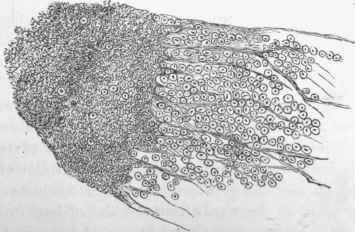 Sclerosis or grey degeneration of cord.