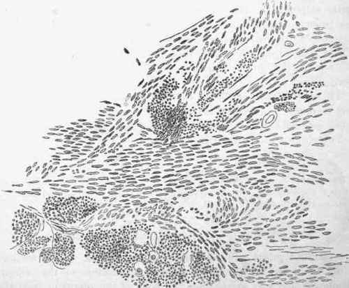Section of a myoma of the uterus stained with carmine.