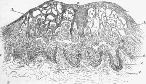 Section of a small pox vesicle. Superficially there is a network formed of the altered epidermis.