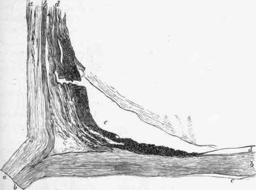Section of portion of a dissecting aneurysm of the aorta.