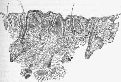 Section of skin in a case of diffuse venous mevus.