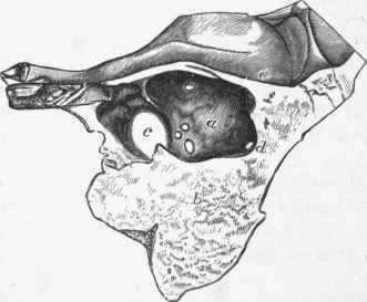 Section showing effects of prolonged otorrhoea.