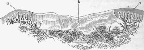Small pox eruption with necrosis, from an injected specimen.