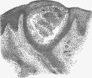 Sudamen formed by dilated sweat duct. It is largely occupied by leucocytes attracted thither, x 80.