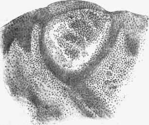 Sudamen formed by dilated sweat duct.