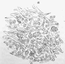 Tertiary Lesions 141