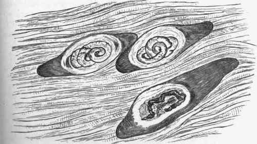 Trichina spiralis in muscle.