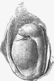 Tuberculosis of testicle. The epididymis is greatly enlarged and partly surrounds the testicle.
