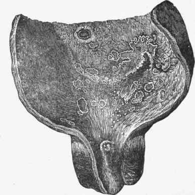 Tuberculosis of the bladder.