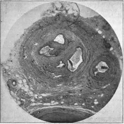 Two veins with organized thrombi in them.