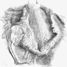 Ulcerated cancer of stomach.