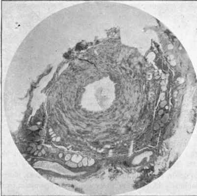 Vein with hypertrophy of its wall from base of varicose ulcer, x 18.