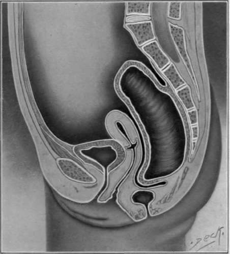 Fig. 14. Malformation in which the peritoneum extends between blind end of the rectum and the normal anus.