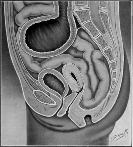 Fig. 15. Entire absence of the recto111. The colon ending in dilated pouch.