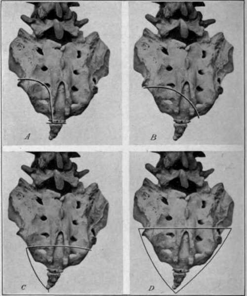 Fig. 16. Methods of sacral resection for locating the rectum. A, Kramerâs; B. Acheneâs; C, Tangierâs; D, He garâs
