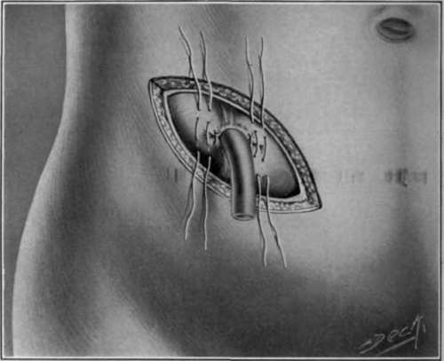 Fig. 18. GibbonÃ¢s valvular colostomy   last tier of sutures.