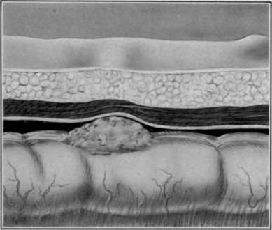 Fig. 21. Periodontists Abscess on outer surface of sigmoid Schematicilia spine along Forepartâs ligament, peritoneal 2. Anterior superior; to the left and slightly below the umbilicus, peritoneal 3. Intramuscular; lying between two layers of the ilia Mesolithic, sub peritoneal. 4. Sacroiliac; lying between that part of the sigmoid which is covered on its front side with peritoneum and the post abdominal wall in the loose tissue. 5. Lumbar abscess; in this variety the pus escapes through Pestâs canal and invades the lumbar region.