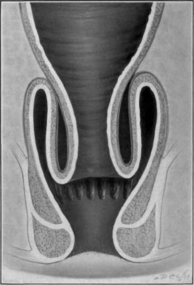 Fig. 30. Complete rectal prolapse, third degree.