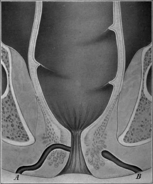 Fig. 36. Fistula A, complete; B, blind external.