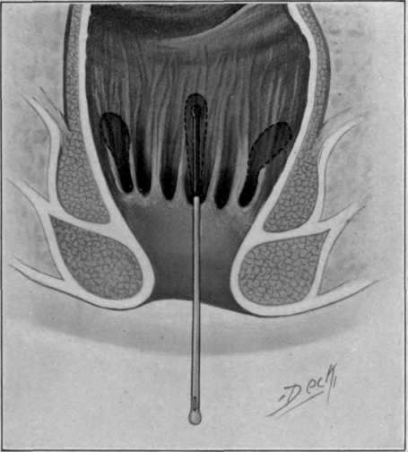 Fig. 40. Sub mucous fistula; arising from valves of Morgan