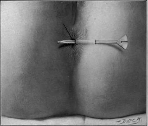 Fig. 41. Showing correct method for incision of fistula The external sphincter is silver, in the form of a saturated solution, or a combination of equal parts of tincture of iodine and carbolic acid, or a solution of dichloride of mercury, are the solutions generally accepted as best for the injection in these cases.