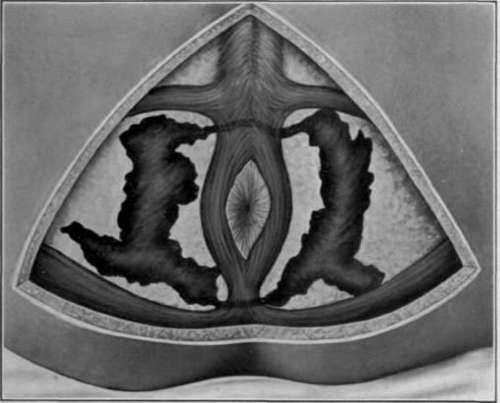 Fig. 46. Horseshoe fistula, diagrammatic.