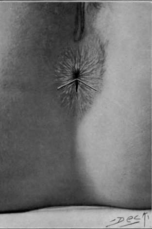 Fig. 48. Fissure in anew Bilateral incision.
