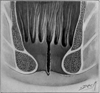 Fig. 49. Tear in crypt of Morgan producing fissure.