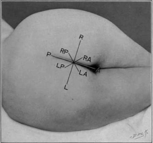 Fig. 50. Subdivision of perinea space (schematic).