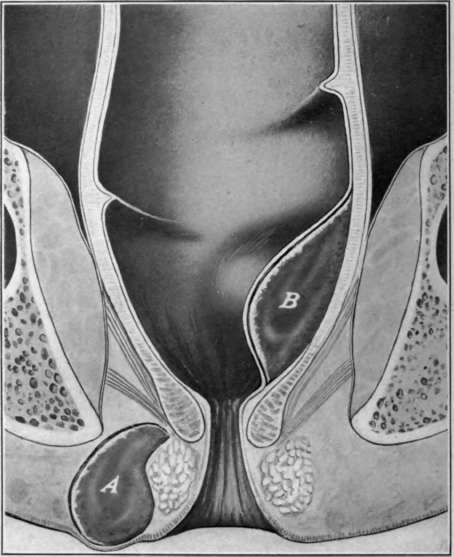 Fig. 51. Rectal abscesses. A, mischief rectal abscess; B, sub mucous abscess.