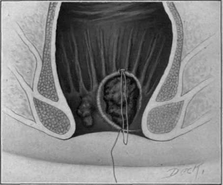 Fig. 61. Sub mucous ligation of hemorrhoid ( Ricketsâs method).