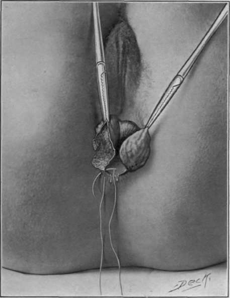 Fig. 65. TittleÃ¢s modification of Whitehead's operation. Sewing subcutaneous sections together, as the pile hearing area is progressively cut away.
