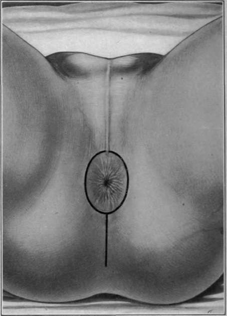 Fig. 78. Skin incision for perinea mastectomy Birminghamâs method.