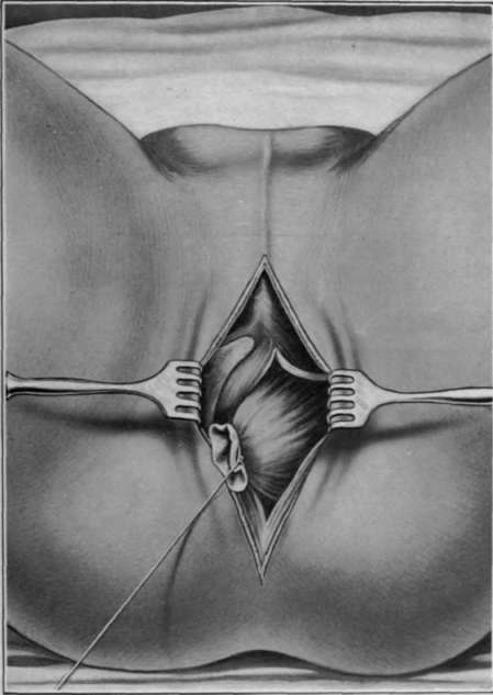 Fig. 79. Perinea extirpation of the rectum. Que nus method.