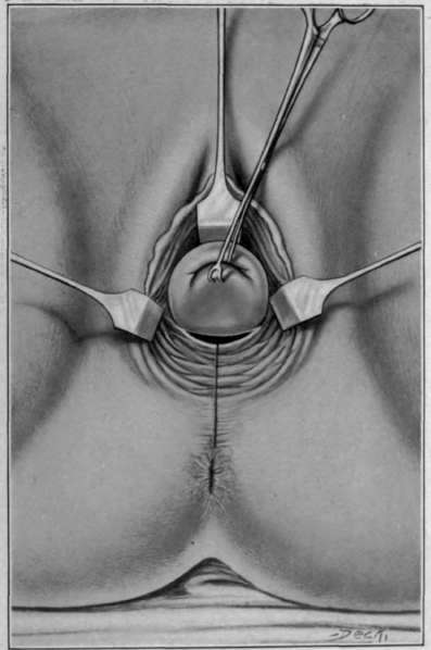 Fig. 84. Vaginal extirpation of rectum. Incisions of vagina and rectum.