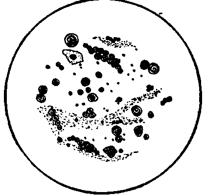 A Specimen of Mucus in the Gastric Juice obtained from a Patient in the Fasting Condition.