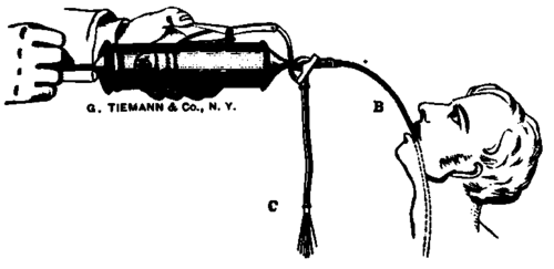 Kussmaul's Stomach Pump.