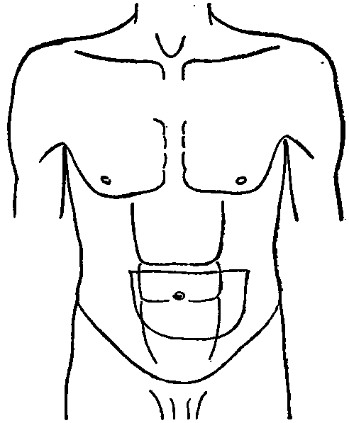 Transilluminated Zone of a Dilated Stomach (patient Wm. U).