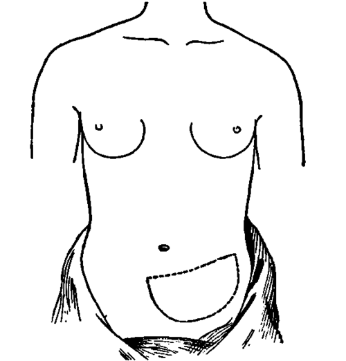 Transilluminated Zone of the Stomach in Gastroptosia (from Mrs. P. F.).