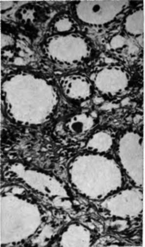 Hormone withdrawal atrophy in a mammary cancer