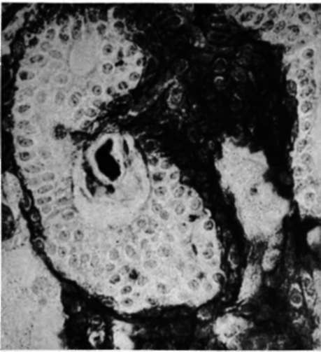 Mammary cancer induced by a single feeding of polynuclear hydrocarbons