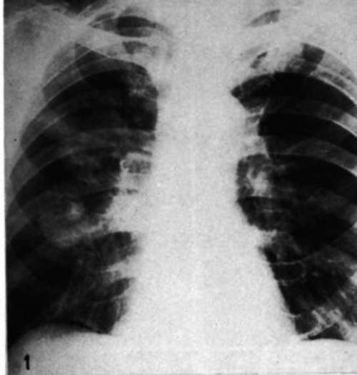 Metastases to both lungs from mammary cancer in a male
