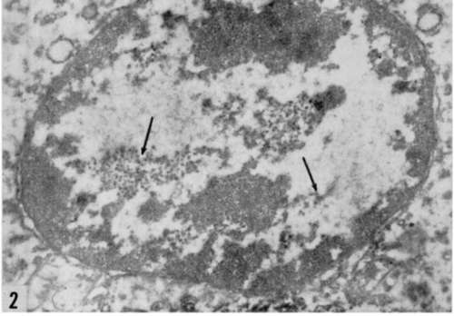 Apparently badly preserved nucleus in cell from Rous sarcoma