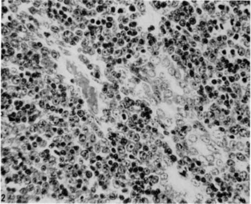 Higher magnification of a parotid tumor