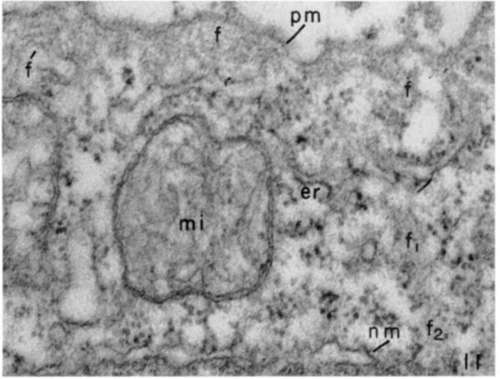 Portion of leukemia tumor cell showing