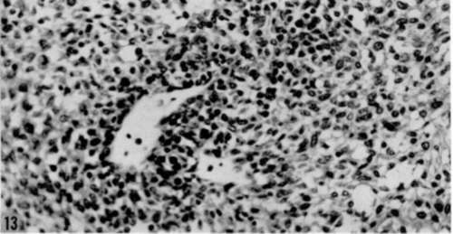 Section of polyoma virus induced tumor of salivary gland
