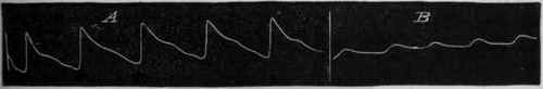 Fig. 120. Tracings from the radial artery at the wrist : A before and B after the application of a cloth dipped in cold water round the arm. (After Winternitz.