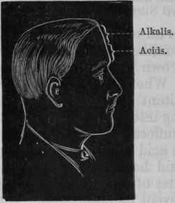 Fig. 165. Showing the position of the frontal headaches relieved by acids and alkalis in the absence of constipation. The lower is relieved by acids, the upper by alkalis before meals.