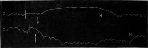 Fig. 72. Tracings from the brain of a dog after trephining, showing the influence of position on the cerebral circulation. In the upper tracing the vertical line shows when the head of the dog was lowered, and in the lower tracing when the head was raised.
